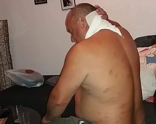 ПРЕЖИВЕО ЧАК 67 УБОДА СТРШЉЕНОВА: Дрвосеча постао медицински феномен